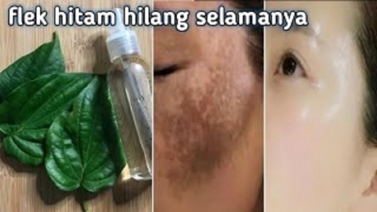 3 Jenis Daun Penghilang Flek Hitam Tebal di Wajah yang Jarang Diketahui, Trik Wajah Glowing Bebas Bitik Hitam