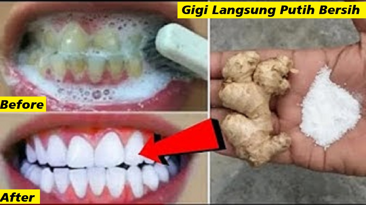 5 Cara Simpel Memutihkan Gigi Kuning yang Membandel Secara Alami, Gigi Putih Bersih Anti Karang dan Plak 