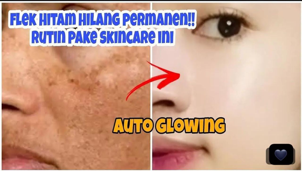 3 Metode Mengelupas Flek Hitam di Wajah Secara Instan Tanpa Pakai Skincare Mahal