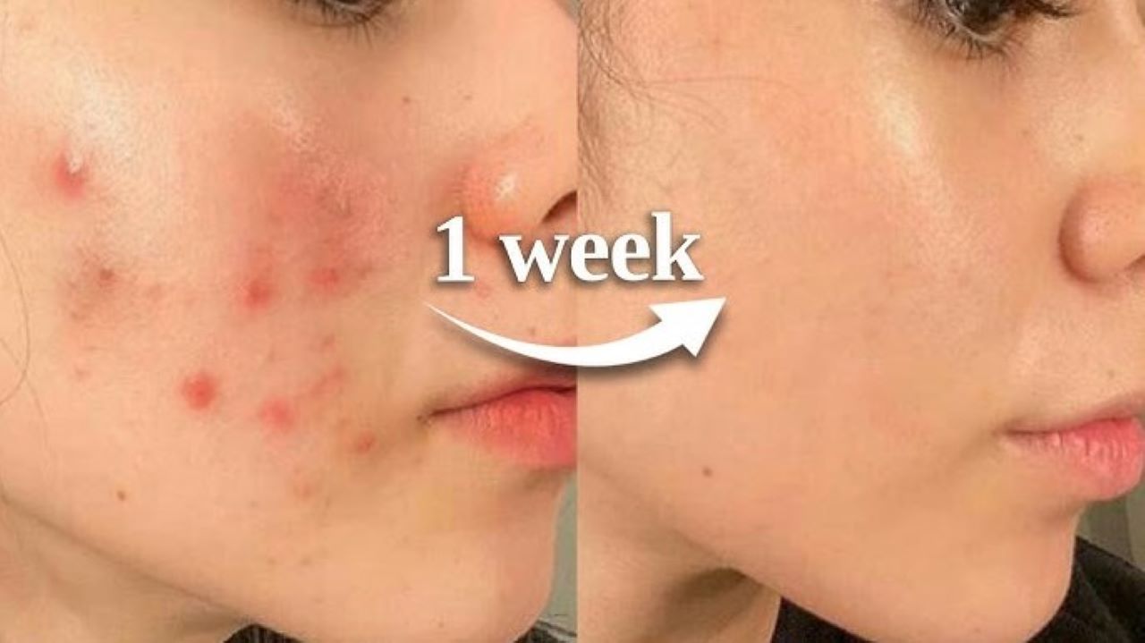 Begini Trik Pakai Air Mawar untuk Mengecilkan Pori-Pori, 1 Bahan Efektif Kontrol Minyak Berlebih  