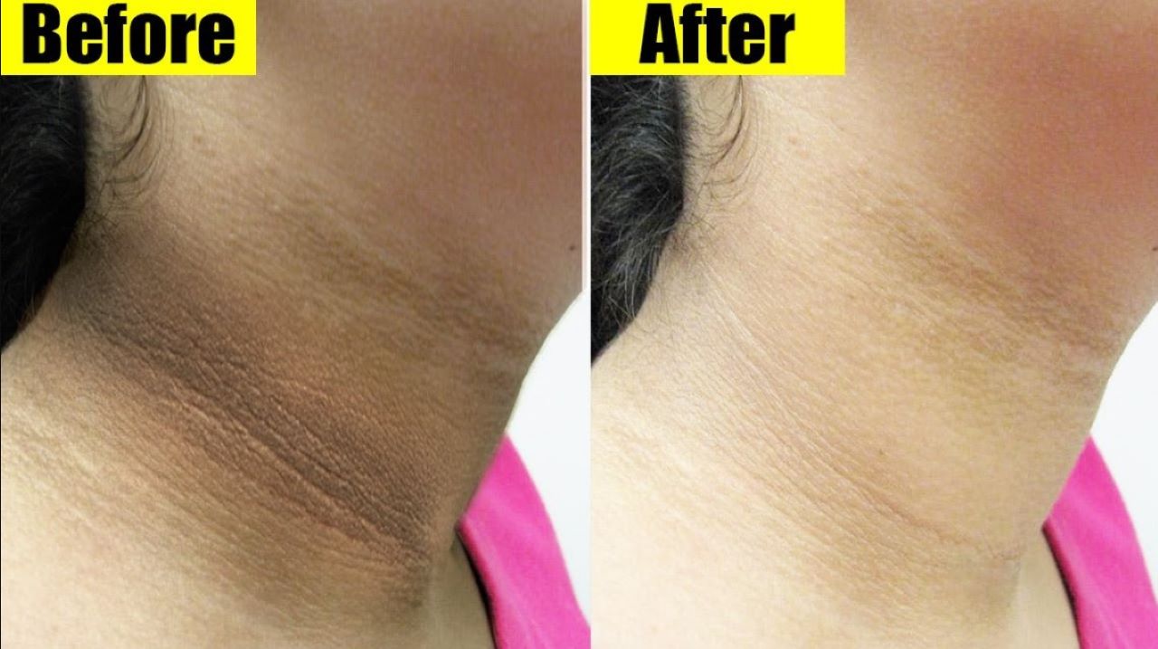 Cara Putihkan Leher Hitam Pakai Beras, Cuma Butuh 4 Langkah Saja 