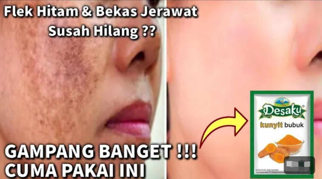 3 Cara Membuat Masker Bubuk Kunyit Desaku untuk Memutihkan Wajah Dalam Semalam, Hilangkan Noda Hitam Permanen