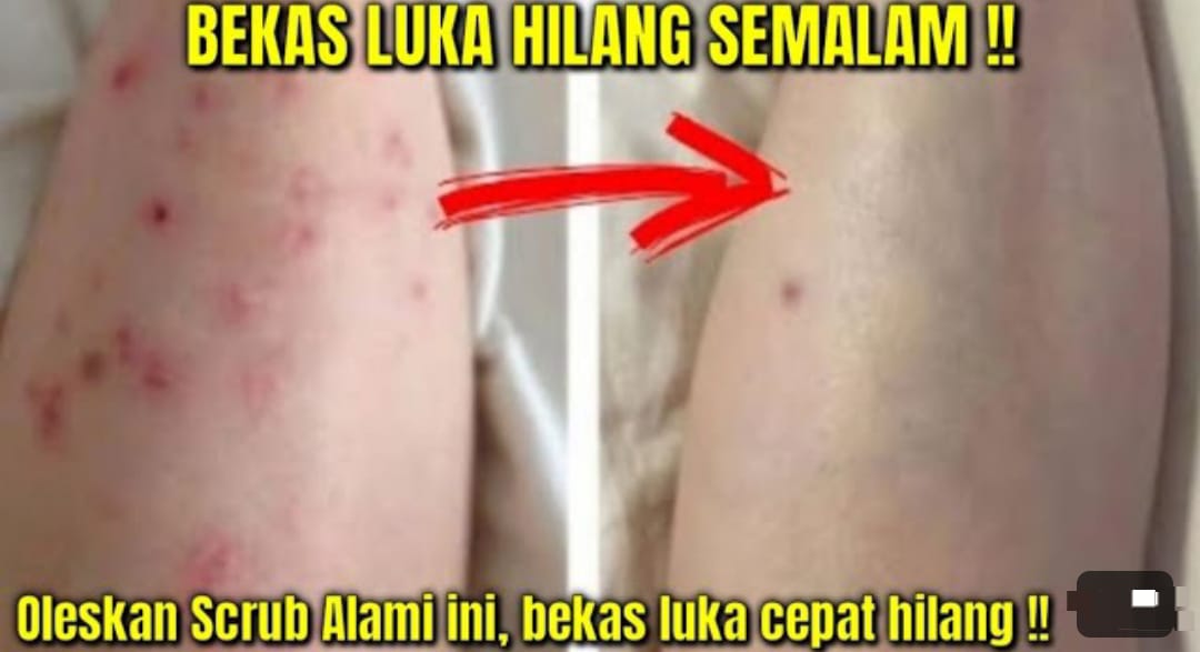 4 Cara Menghilangkan Bekas Luka Hitam di Kaki Secara Alami dan Hasilnya Putih Permanen, Kulit Bebas Noda Hitam