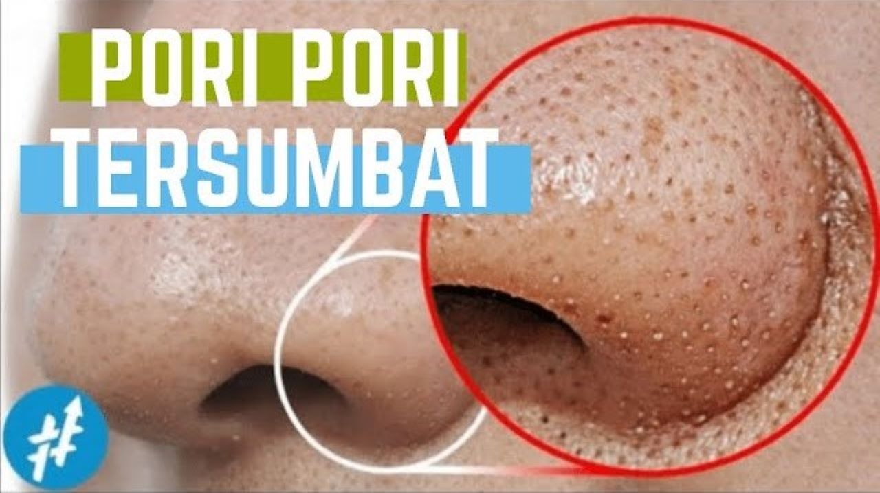 Cara Membersihkan Pori-Pori yang Tersumbat, Modal 2 Bahan Alami Saja Cegah Komedo