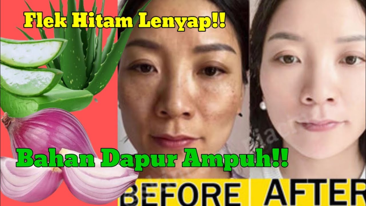 Rahasia Menghilangkan Flek Hitam di Wajah Secara Alami dan Cepat, Kulit Glowing Merata Hanya Pakai 5 Bahan ini