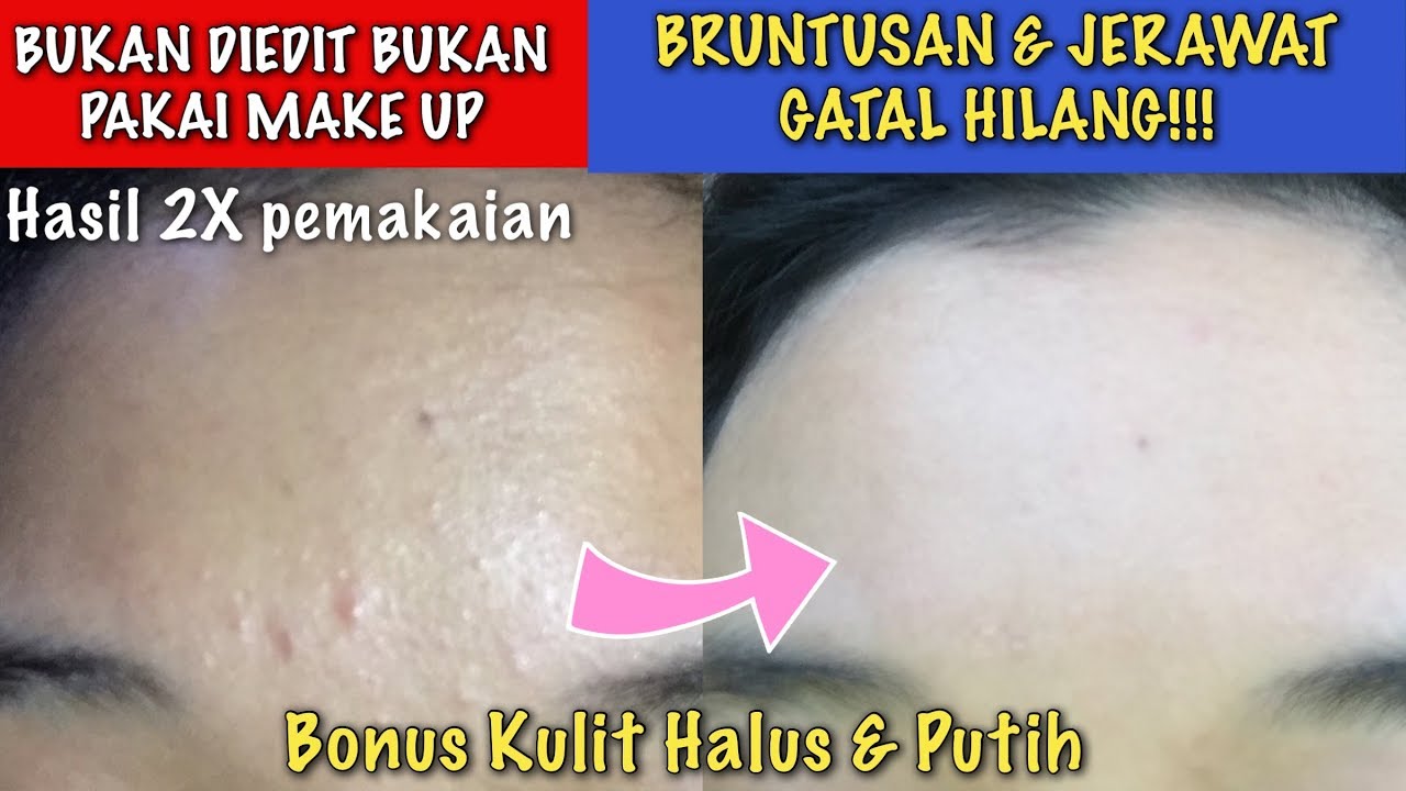 2 Cara Mengatasi Bruntusan Tanpa Skincare, Rahasia Kulit Wajah Halus dan Glowing