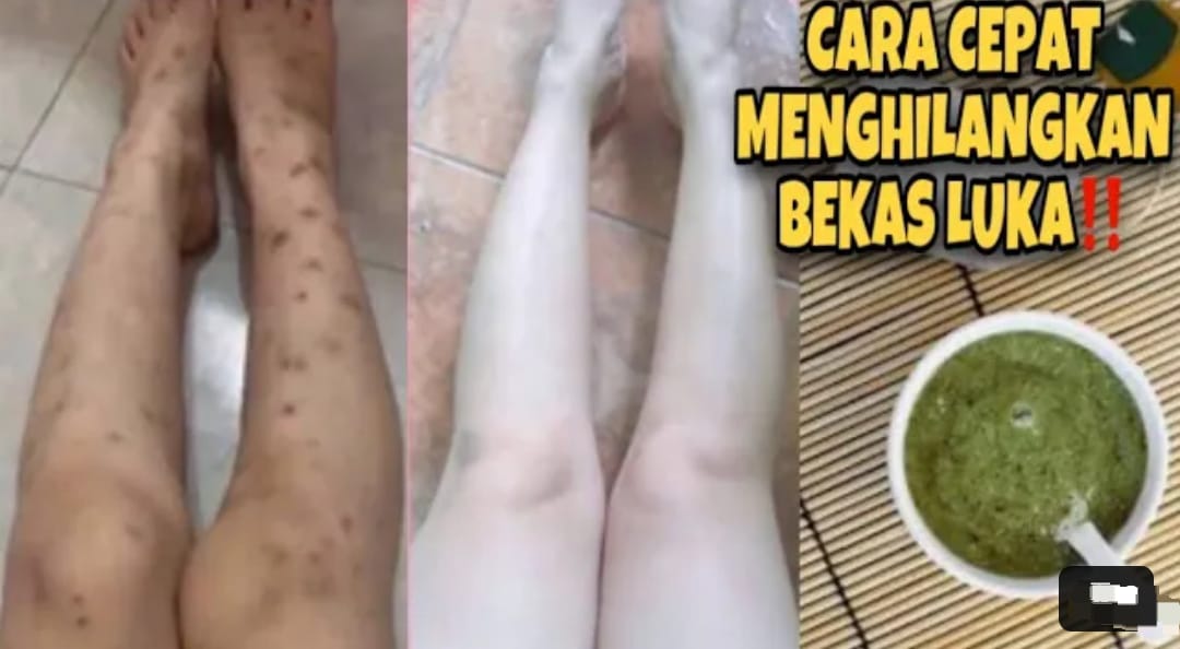 2 Cara Menghilangkan Koreng di Kaki yang Menghitam secara Alami dan Permanen, Kulit Kenyal Putih Bebas Noda