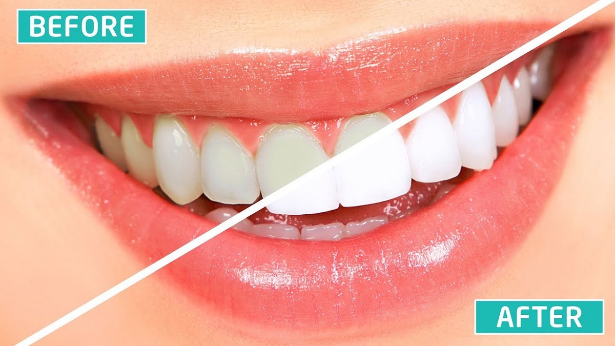 5 Merek Pasta Gigi yang Bisa Memutihkan Gigi Secara Instan dan Permanen dalam 1 Malam Bebas Plak dan Karang