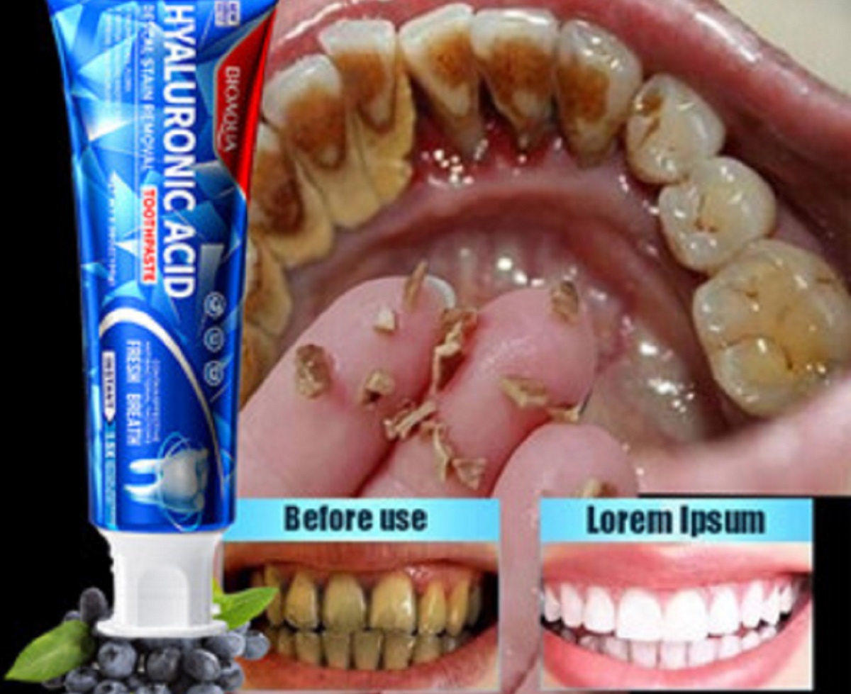 Inilah 5 Rekomendasi Obat untuk Membersihkan Karang Gigi Paling Ampuh