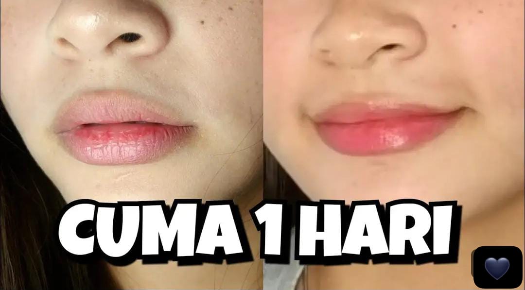 4 Cara Mengatasi Bibir Kering dan Pecah-Pecah Secara Alami Agar Plumpy