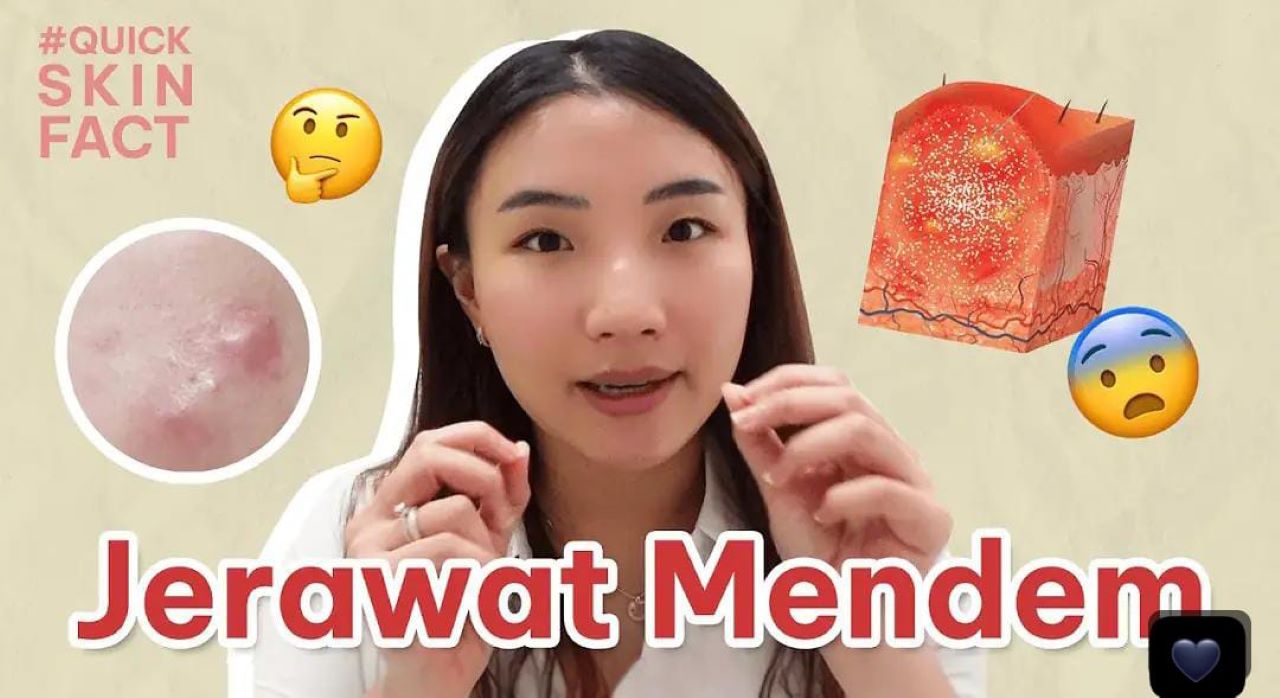 5 Metode Menghilangkan Jerawat Secara Alami Tanpa Modal Agar Kulit Mulus