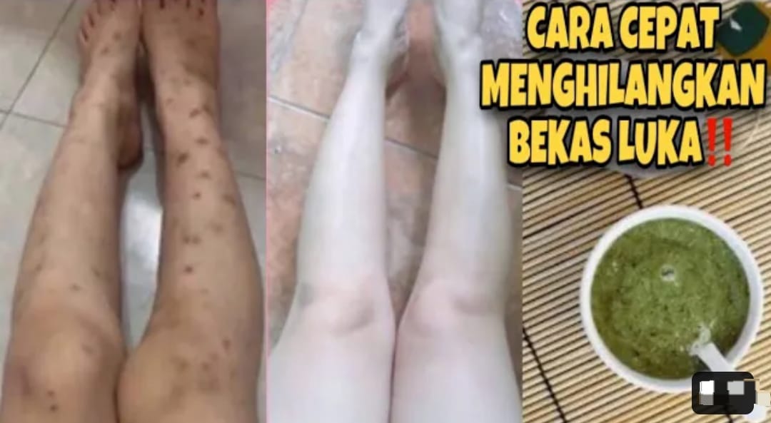 3 Cara Menghilangkan Bekas Luka di Kaki Akibat Gatal yang Menghitam Secara Alami, Kulit Bebas Koreng Permanen