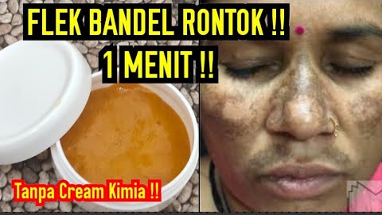 Ini Dia Cara Menghilangkan Hiperpigmentasi di Wajah Secara Alami, Cuma 3 Langkah