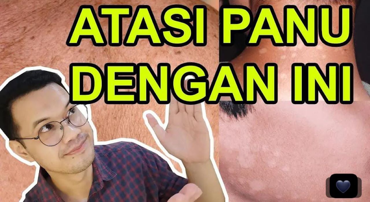 3 Tips Menghilangkan Panu di Wajah Secara Alami Dalam Satu Kali Usap Langsung Hilang