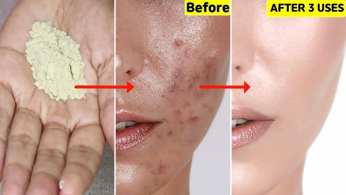 Ternyata, Ini Cara Menghilangkan Flek Hitam Di Pipi dengan Cepat Pakai Bahan Dapur Bikin Glowing Alami