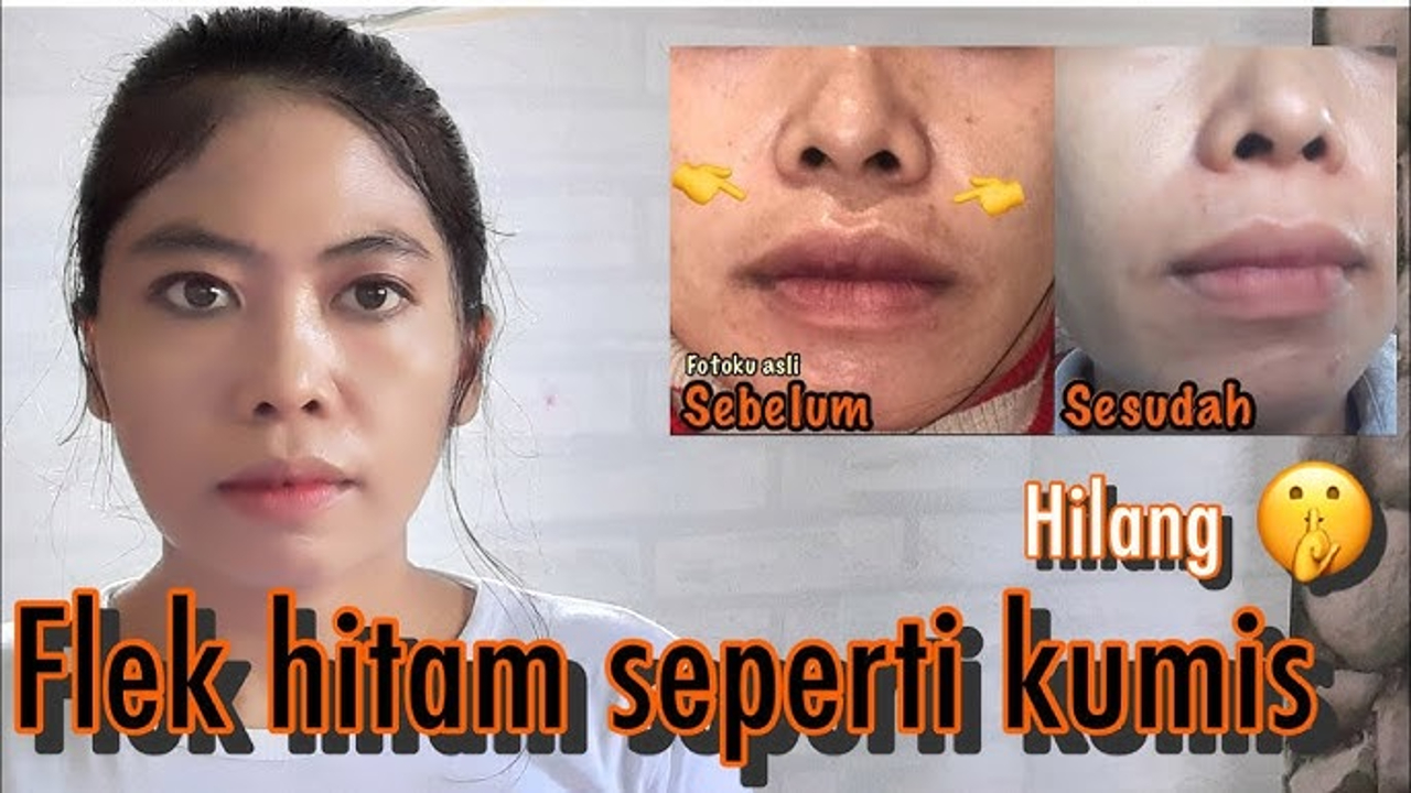 3 Cara Menghilangkan Flek Hitam Seperti Kumis dengan Cepat, Gampang Banget!