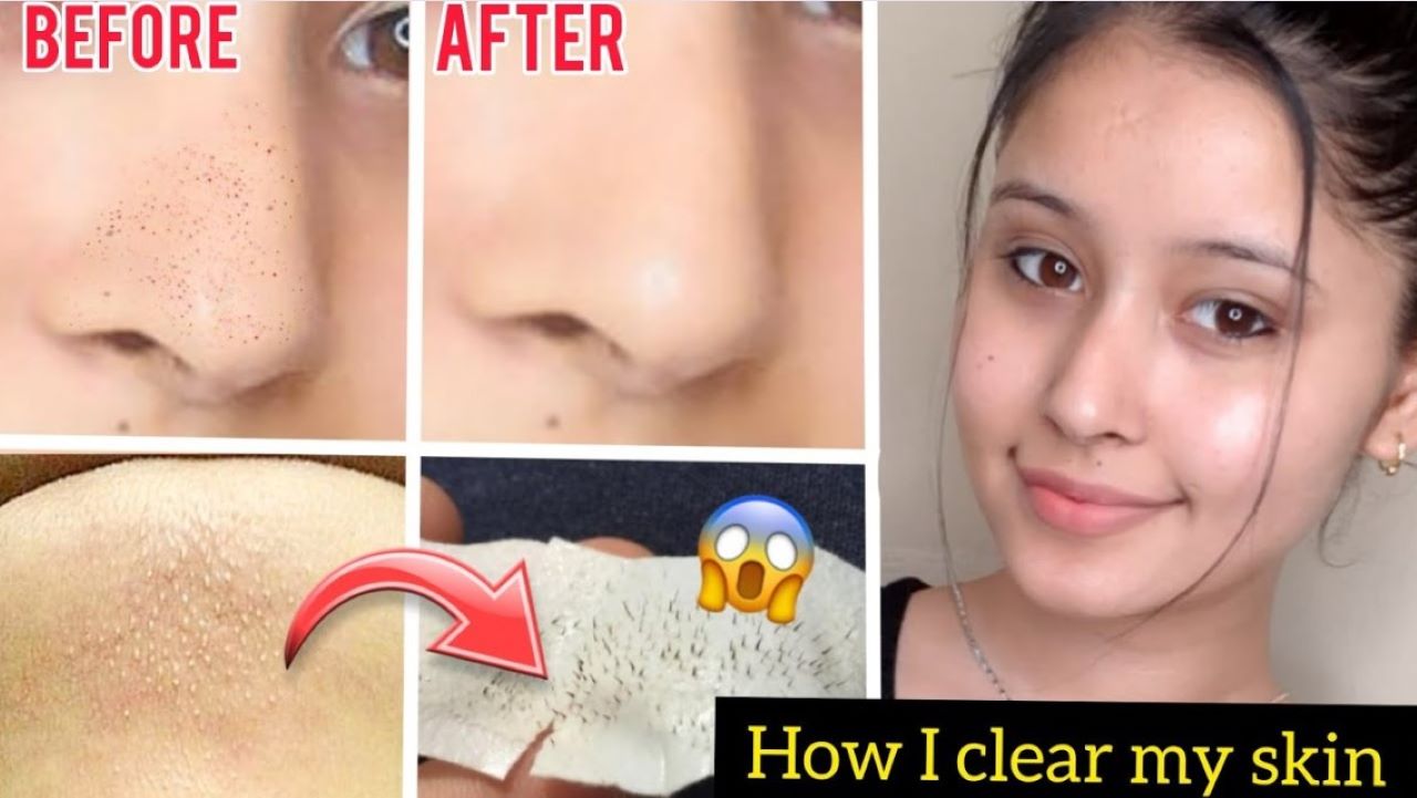 5 Cara Menghilangkan Komedo yang Paling Mudah dengan Bahan Alami, Kulit Mulus Tanpa Budget Mahal