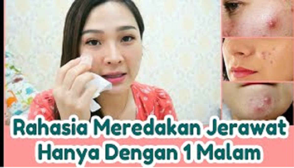 Ampuh! Racikan Obat Totol Jerawat Alami Hilangkan Jerawat 1 Malam 