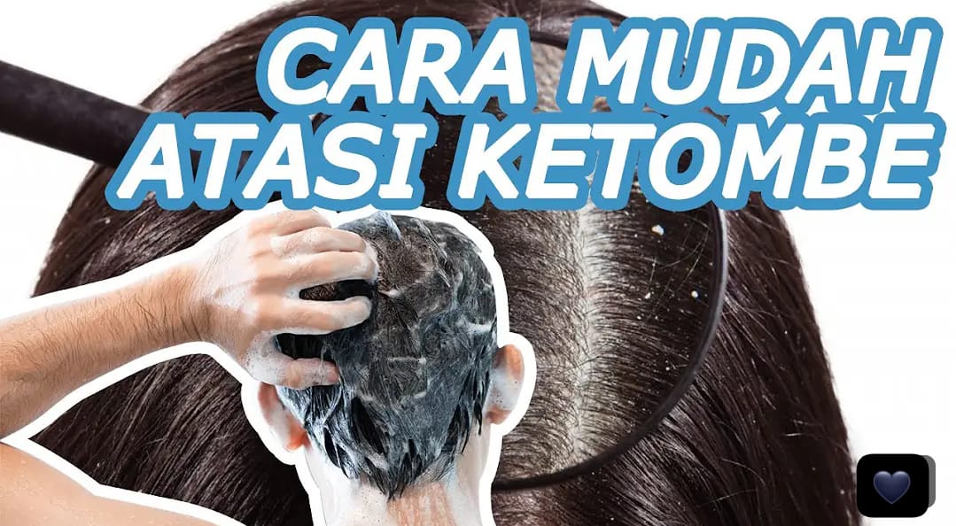 4 Cara Menghilangkan Ketombe Secara Alami Agar Tidak Muncul Lagi Permanen