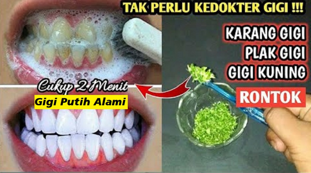 3 Cara Simpel Membersihkan Karang Gigi yang Sudah Mengeras, Bikin Gigi Putih Bersih Bebas Plak dan Noda Hitam