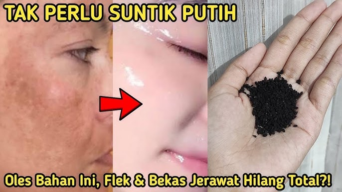 4 Bahan Alami Pengelupas Flek Hitam dalam 1 Malam, Wajah Glowing Keesokan Harinya