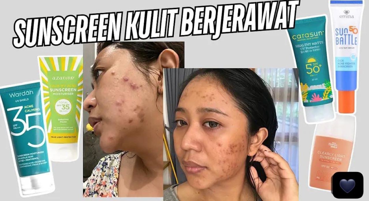 3 Pilihan Sunscreen yang Cocok untuk Kulit Berjerawat dan Kulit Sensitif! Aman Tidak Bikin Lengket