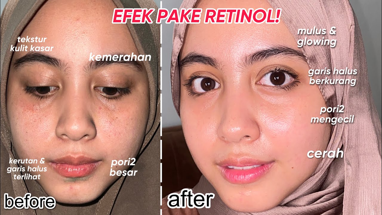 Bagaimana Penggunaan Retinol yang Benar? Ini 5 Caranya Agar Wajah Glowing Awet Muda Bebas Iritasi