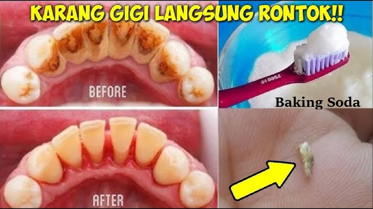 Gak Nyaman Sama Gigi Kuning? Begini 5 Cara Merontokkan Karang Gigi Tebal Secara Efektif dan Cepat