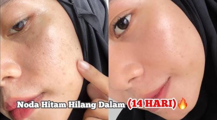 5 Obat Penghilang Flek Hitam di Apotik, Cara Cepat Wajah Putih Glowing Awet Muda Anti Ribet