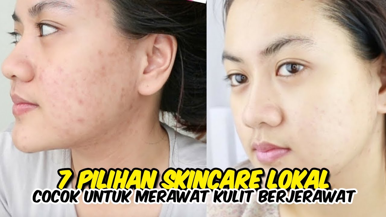 7 Skincare Lokal untuk Kulit Berjerawat, Harga di Bawah 100 Ribuan Dijamin Kulit Kembali Mulus