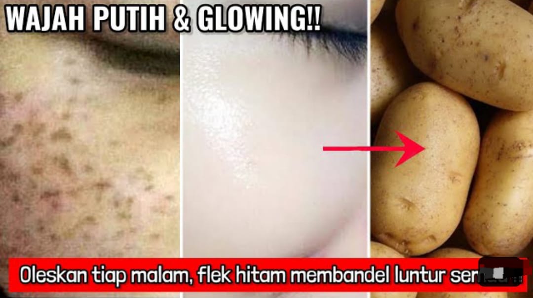 5 Cara Hilangkan Noda Hitam di Wajah dengan Bumbu Dapur, Kulit Mulus Awet Muda Untuk Usia 50 Tahun Ke Atas