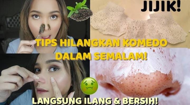 Cara Menghilangkan Komedo dengan Bahan Alami dalam 1 Malam, Pori-Pori Mengecil Kulit Jadi Mulus Permanen