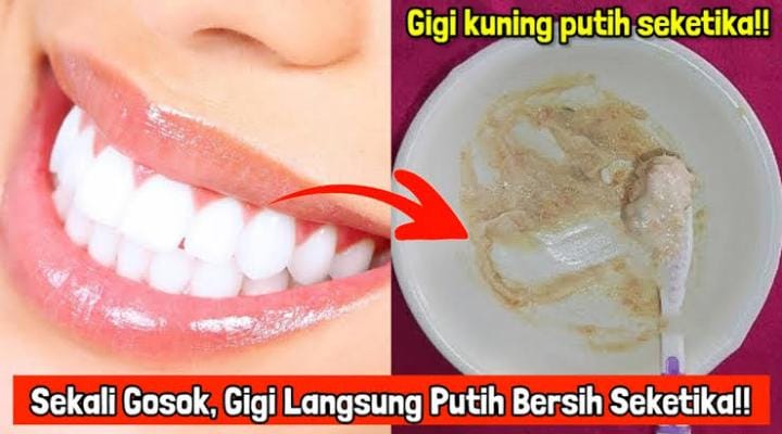 2 Cara Menggunakan Minyak Kelapa untuk Memutihkan Gigi, Bersihkan Plak Bau Mulut dan Cegah Gigi Berlubang