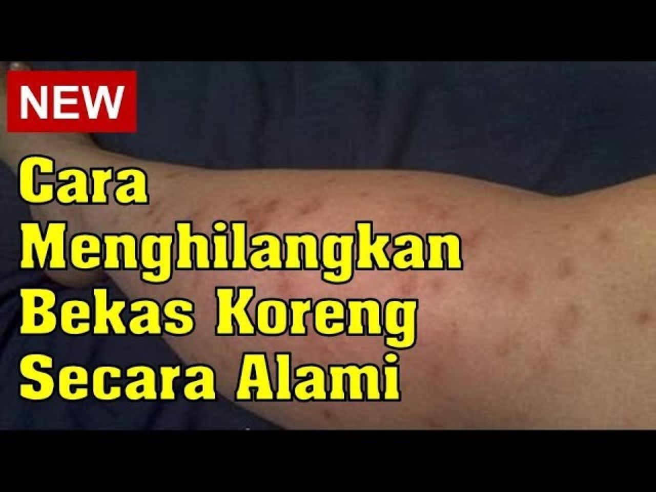 3 Cara Menghilangkan Bekas Luka Hitam dan Koreng Secara Alami yang Aman Tanpa Iritasi