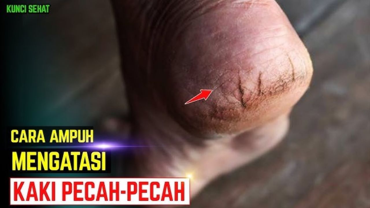 Cara Menghaluskan Tumit Kaki Pecah-Pecah, Pakai 2 Bahan yang Mudah Ditemukan di Pekalongan