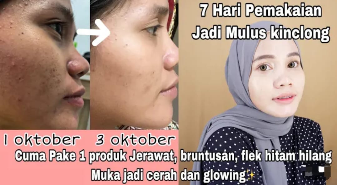 Cara Cepat Menghilangkan Flek Hitam dengan Bahan Alami Kulit Langsung Putih Glowing Awet Muda dan Bebas Noda