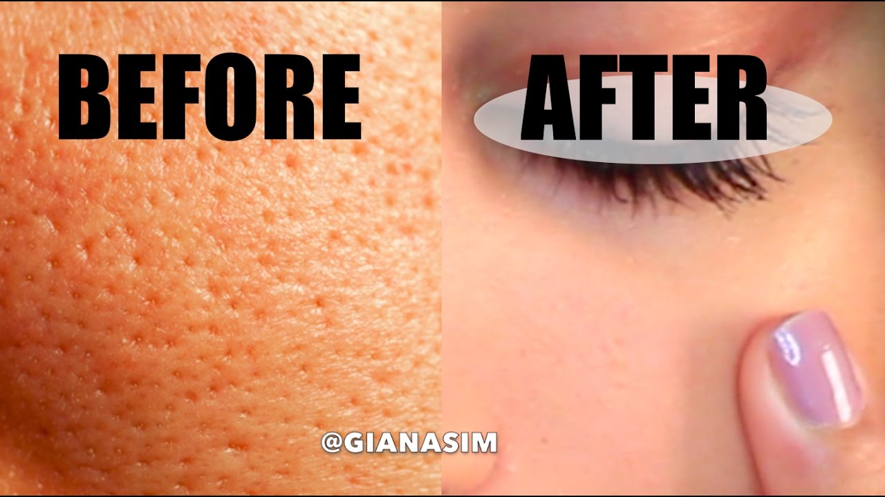 3 Cara Menyamarkan Pori-Pori Besar Agar Cepat Mengecil Secara Alami, Hasil Glowing dan Mulus!