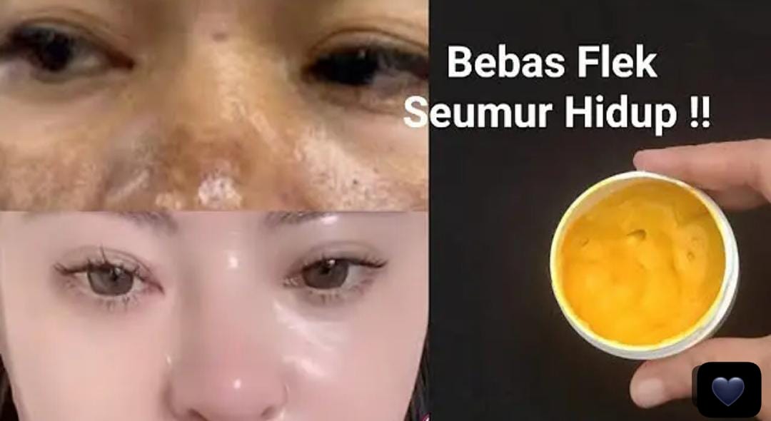 Racikan DIY Cream Penghilang Flek Hitam dan Pemutih Wajah, Kulit Langsung Glowing Hanya Dalam 2 Langkah!