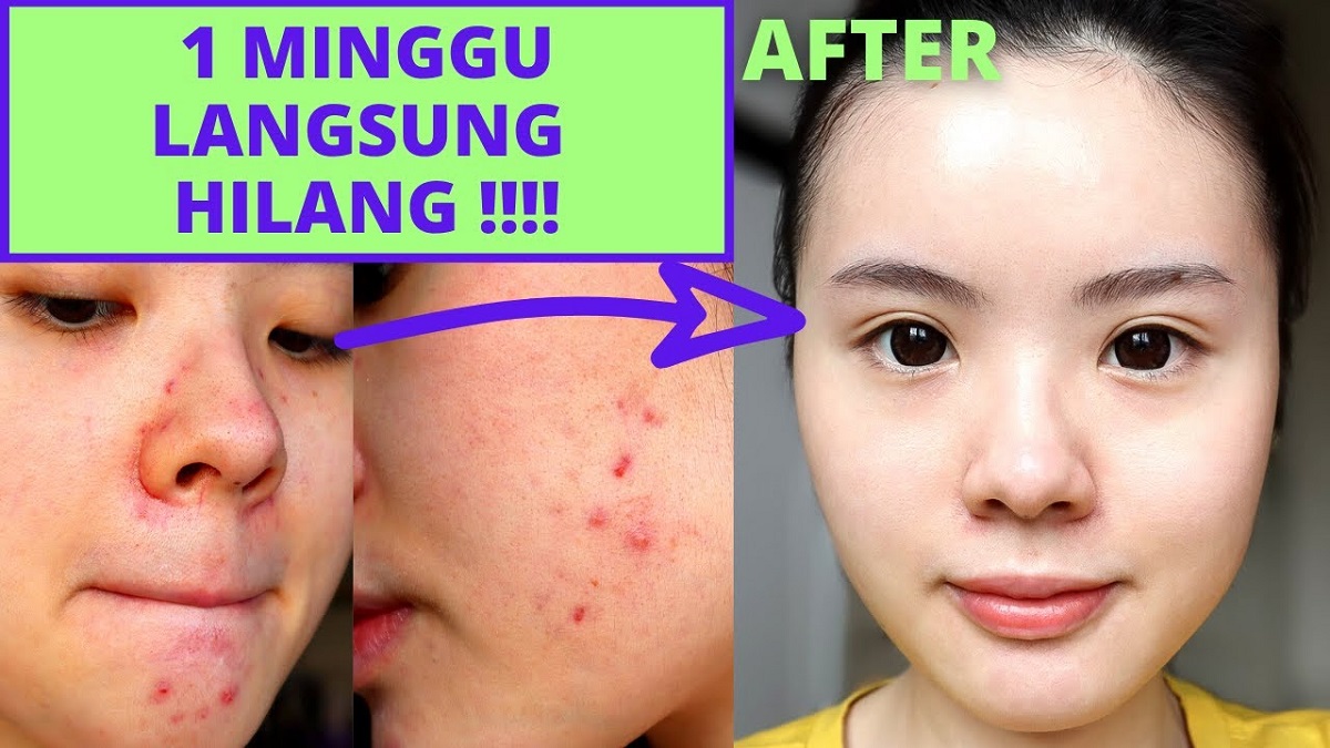 7 Serum Wardah untuk Menghilangkan Bekas Jerawat di Wajah, Kulit Cerah Bebas Noda Hingga Glowing Sempurna