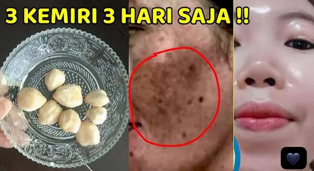 Tips Pakai Minyak Kemiri untuk Wajah Agar Bebas Penuaan Dini dan Flek Hitam