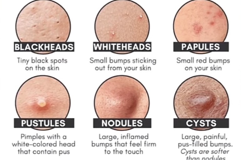 Sering Muncul Jerawat Saat Puasa?Ini 5 Cara Mencegah Breakout Selama Ramadan