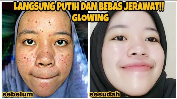 Cara Menghilangkan Jerawat dengan Cepat dalam 1 Hari, Permanen Cuma Pakai Bahan Alami Tanpa Skincare Mahal