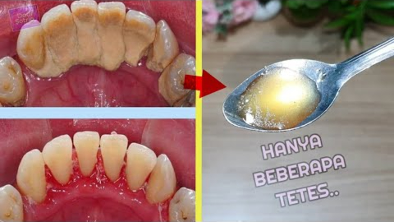 3 Cara Membersihkan Karang Gigi Secara Alami Tanpa Perlu Ke Dokter