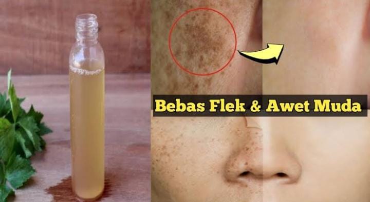 Cara Membuat Toner Cuka Apel untuk Menghilangkan Flek Hitam Parah, Sesuaikan dengan Jenis Kulitmu