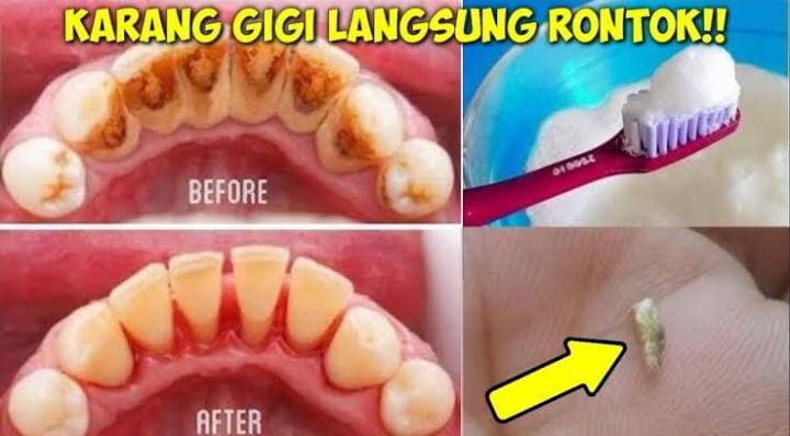 Begini Cara Merontokkan Plak Hitam di Gigi dengan Cepat, Bersih Permanen Cuma Pakai 1 Jenis Rempah