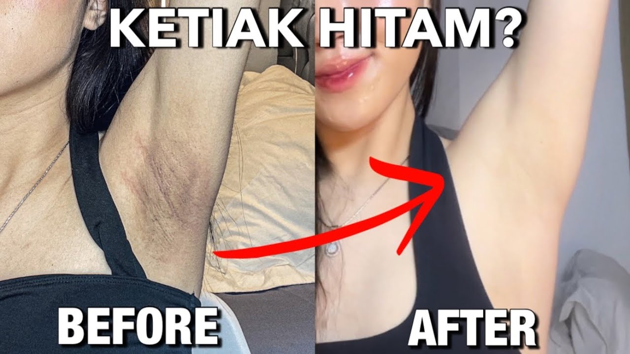 Begini Cara Memutihkan Ketiak Hitam Secara Alami, Cuma Pakai 1 Bahan Dapur Jadi Mulus Bebas Keringat