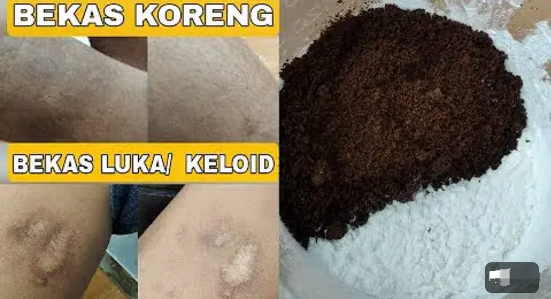 3 Cara Menghilangkan Bekas Luka Bakar yang Menghitam Dalam 1 Malam, Pakai Bahan Dapur Kulit langsung Mulus