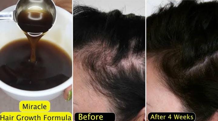 3 Bahan Dapur untuk Menumbuhkan Rambut Botak dan Rontok, Begini Cara Pakainya Agar Rambut Lebat dan Tebal Lagi