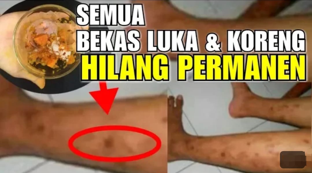 3 Cara Menghilangkan Bekas Hitam di Kaki Secara Alami Dalam Semalam, Cuma 1 Bahan Dapur Kulit Putih Bebas Noda