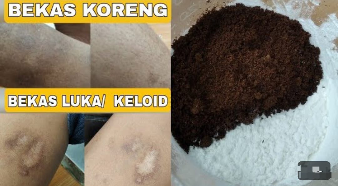 4 Cara Menghilangkan Bekas Koreng di Kaki yang Sudah Lama Secara Alami, Kulit Menghitam jadi Putih Permanen